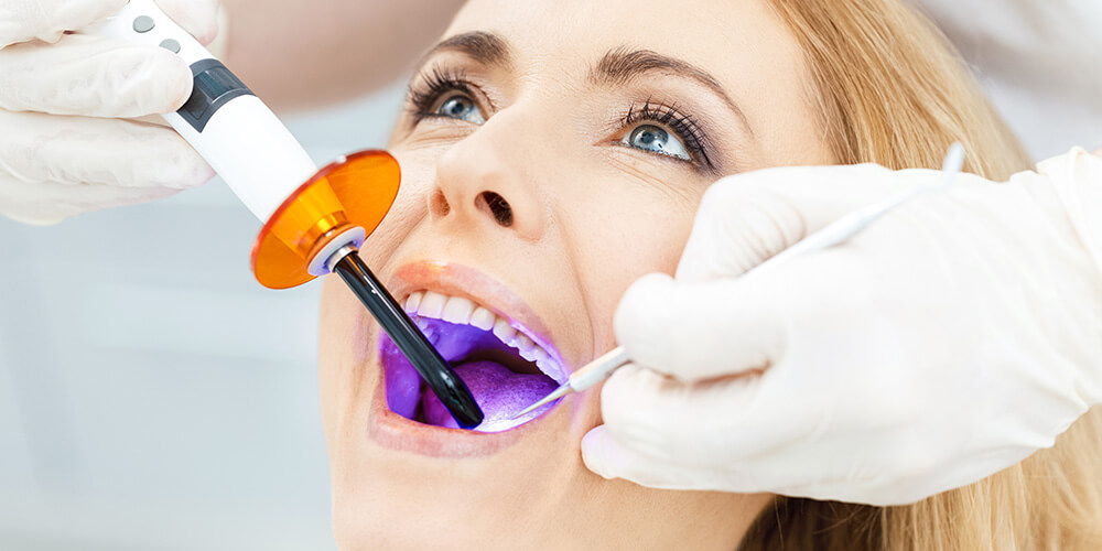 Dental Bonding Brampton