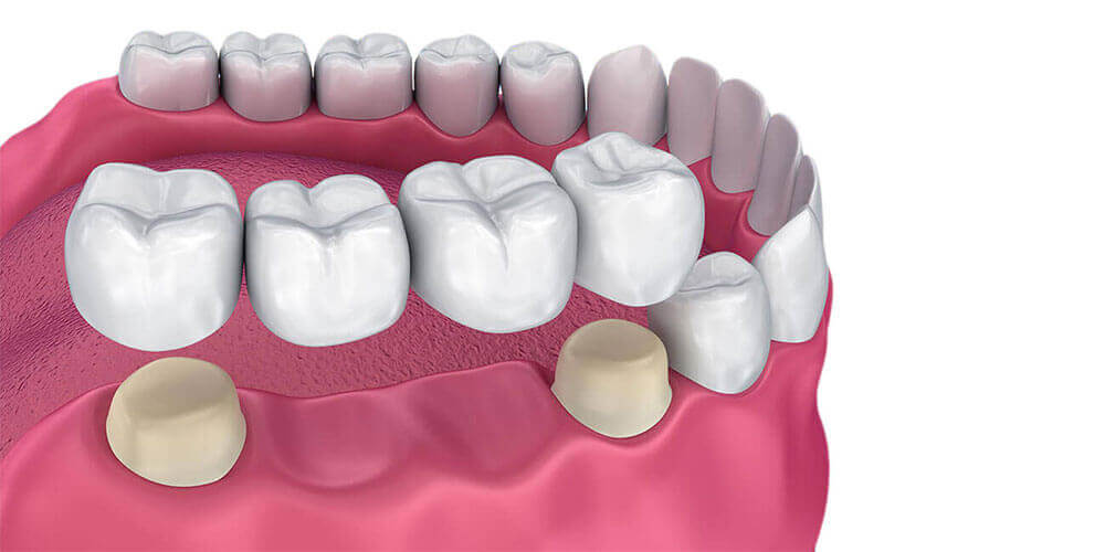 Dental Bridges Brampton