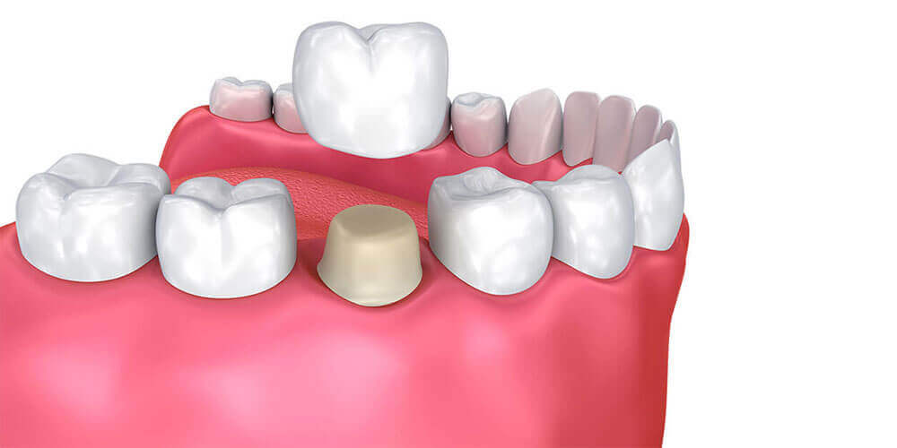 Dental Crowns Brampton