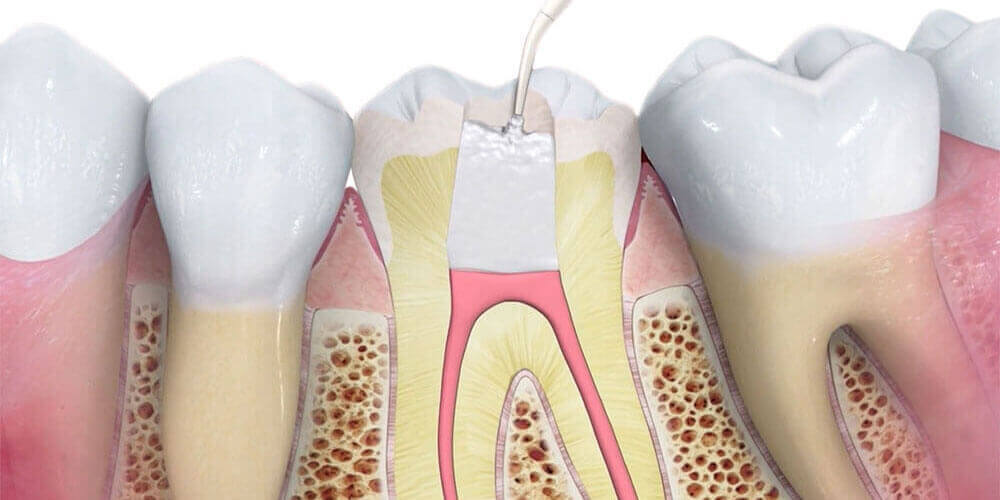 Root Canal Treatment Brampton