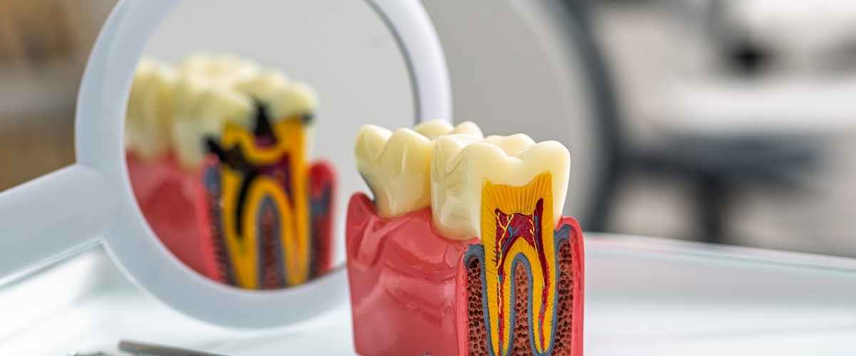 A Clear Guide to How Tooth Decay Progresses